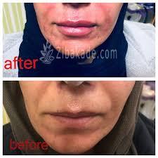 میکرونیدلینگ